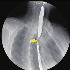 Image Description (Peptic Stricture): A barium swallow showing a smooth, tapered, focal area of narrowing in the distal esophagus, commonly caused by chronic acid reflux.