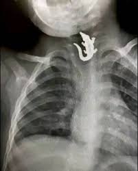 Image Description (Achalasia - "Bird's Beak"): A classic, smooth, "bird’s beak" narrowing of the lower esophageal sphincter with massive dilation of the esophagus above it.