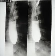Difficulty 2 in swallowing – Suspected Esophageal Stricture Difficulty 2 in swallowing – Suspected Esophageal Stricture