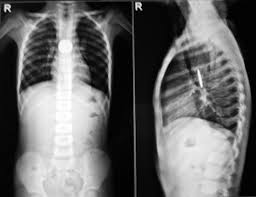 Difficulty 2 in swallowing – Suspected Esophageal Stricture Difficulty 2 in swallowing – Suspected Esophageal Stricture