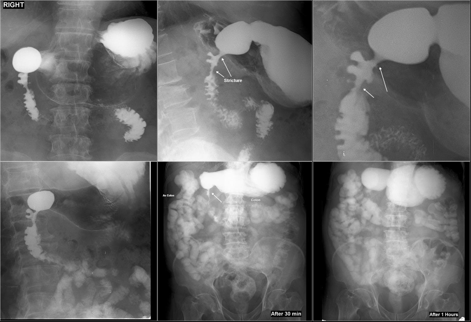 67/Male with symptoms of Gastric outlet obstruction (GOO) distension of stomach, vigurous peristalsis, hold up with stricture of D1- proximal D2