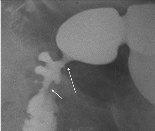 Radiological signs of a deformed duodenal bulb, often caused by chronic scarring from peptic ulcer disease, include a "cloverleaf" appearance (due to multiple pseudodiverticula and spasm), persistent irregularity, and base line tenting. Other signs include ulcer craters, narrowing, and, in severe cases, strictures or "pseudodiverticulum" formation. 